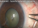 Riskli kataraktlar - lazer katarakt cerrahisi - travmatik katarakt
